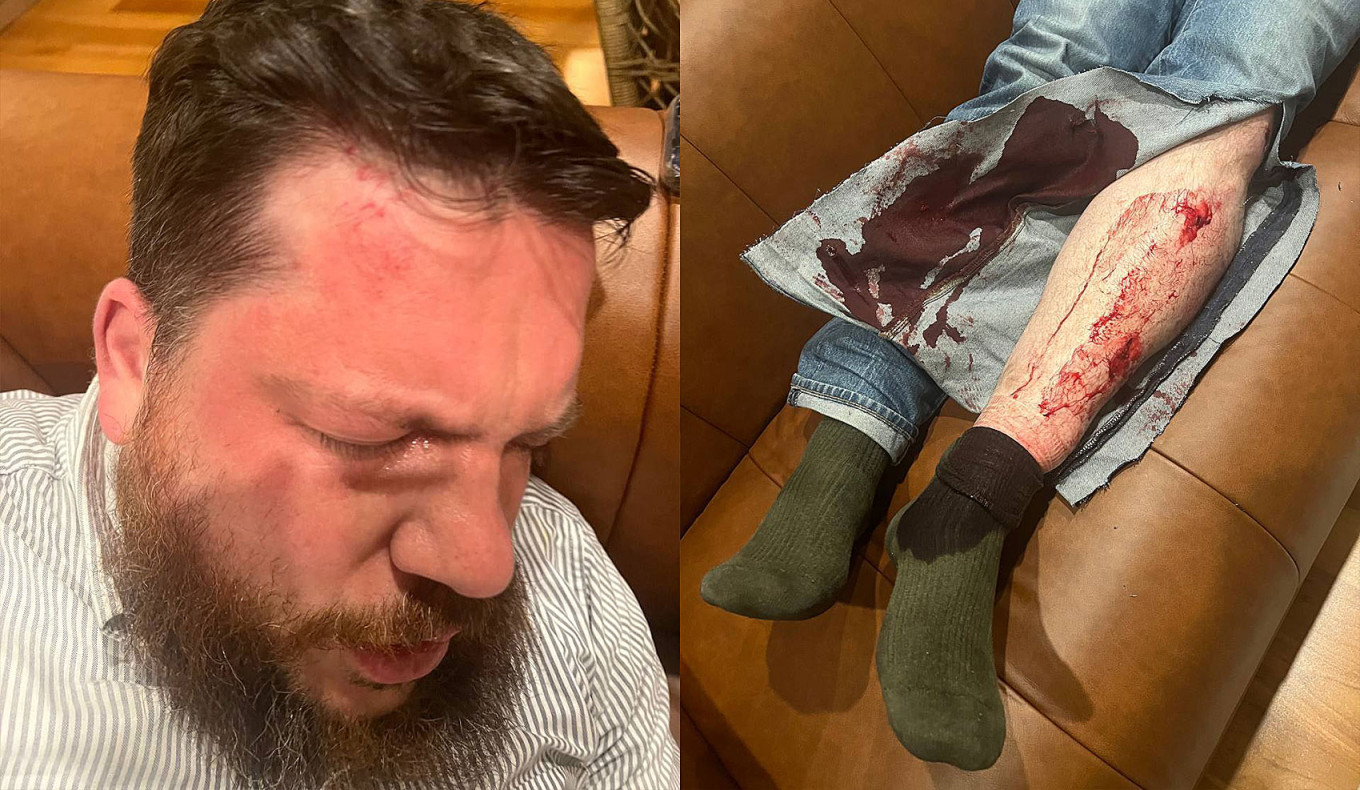 
					Leonid Volkov's wounds after he was attacked outside his home in Vilnius.					 					Ivan Zhdanov / Telegram				